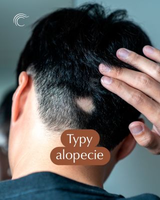 Alopecie. Jedno slovo, mnoho podob. Ne každé padání vlasů má stejný příběh a právě v tom spočívá klíč k účinné léčbě....
