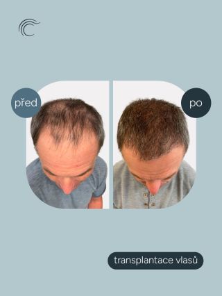 Proměny našich klientů ukazují, jaký rozdíl dokáže přinést precizní práce našich lékařů. 👩‍⚕️ Každý klient u nás prochází...