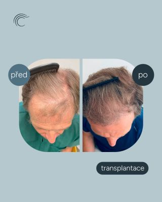 Přirozený výsledek, který vrací sebevědomí. 🙌 Transplantace vlasů dokáže obnovit nejen hustotu, ale i jistotu, se kterou...
